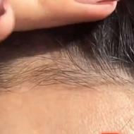 درمان ریزش مو ورویش مجدد مو