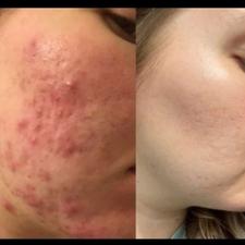 رفع هرگونه جوش در یک هفته ( با تضمین)