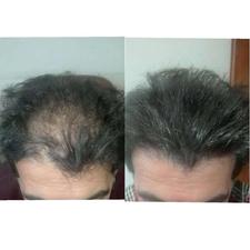 درمان قطعی ریزش مو و هر نوع مشکل مویی