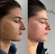 درمان کک ومک ولک بارداری و منافذ باز پوست