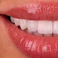 زیبایی دندان ، کامپوزیت، روکش، لمینیت