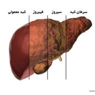 اصلاح کبد چرب