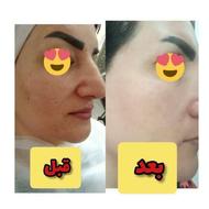 فشیال صورت......