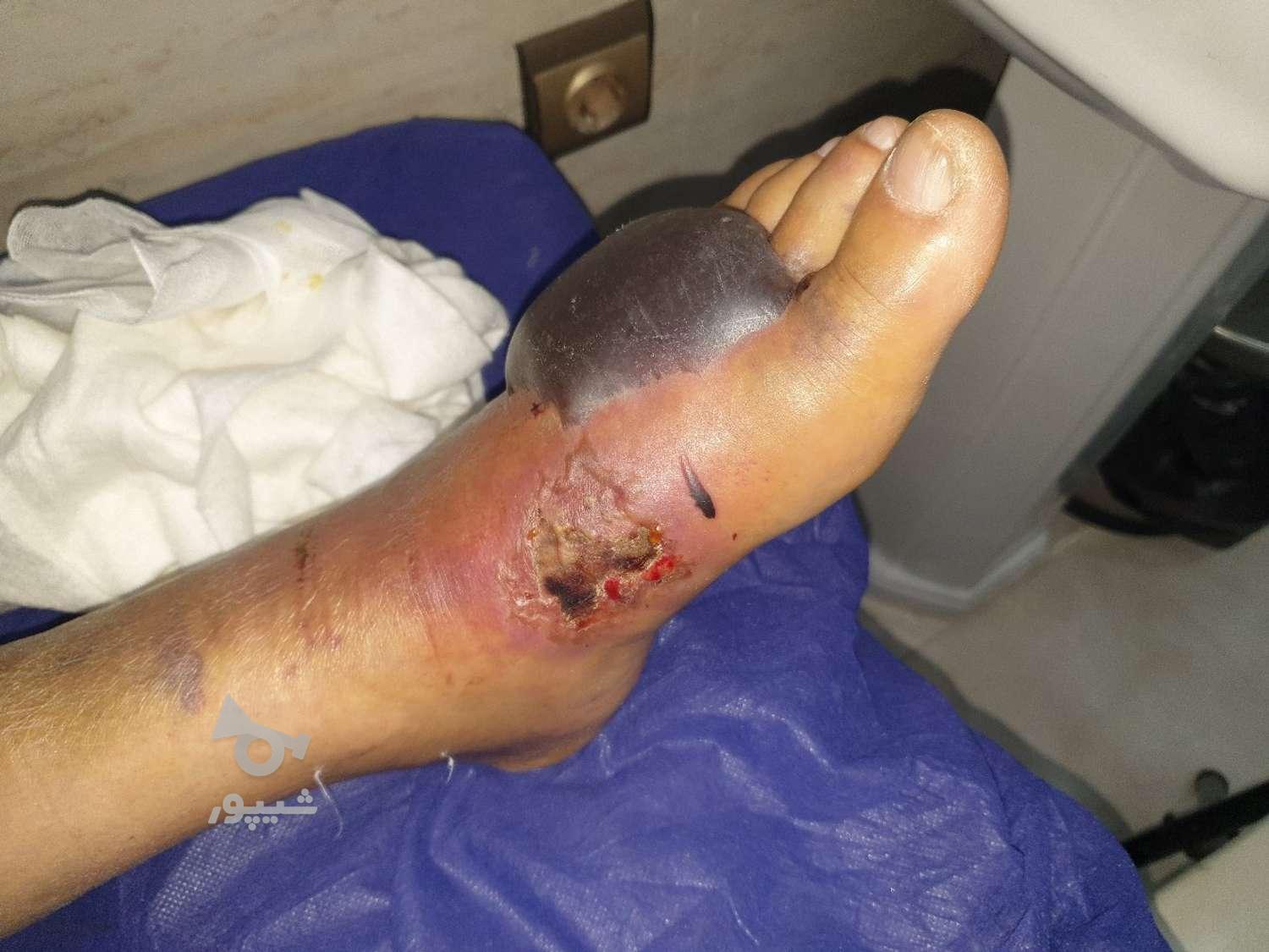 درمان انواع زخم پای دیابتی/بستر/جراحی/ارتوپدی