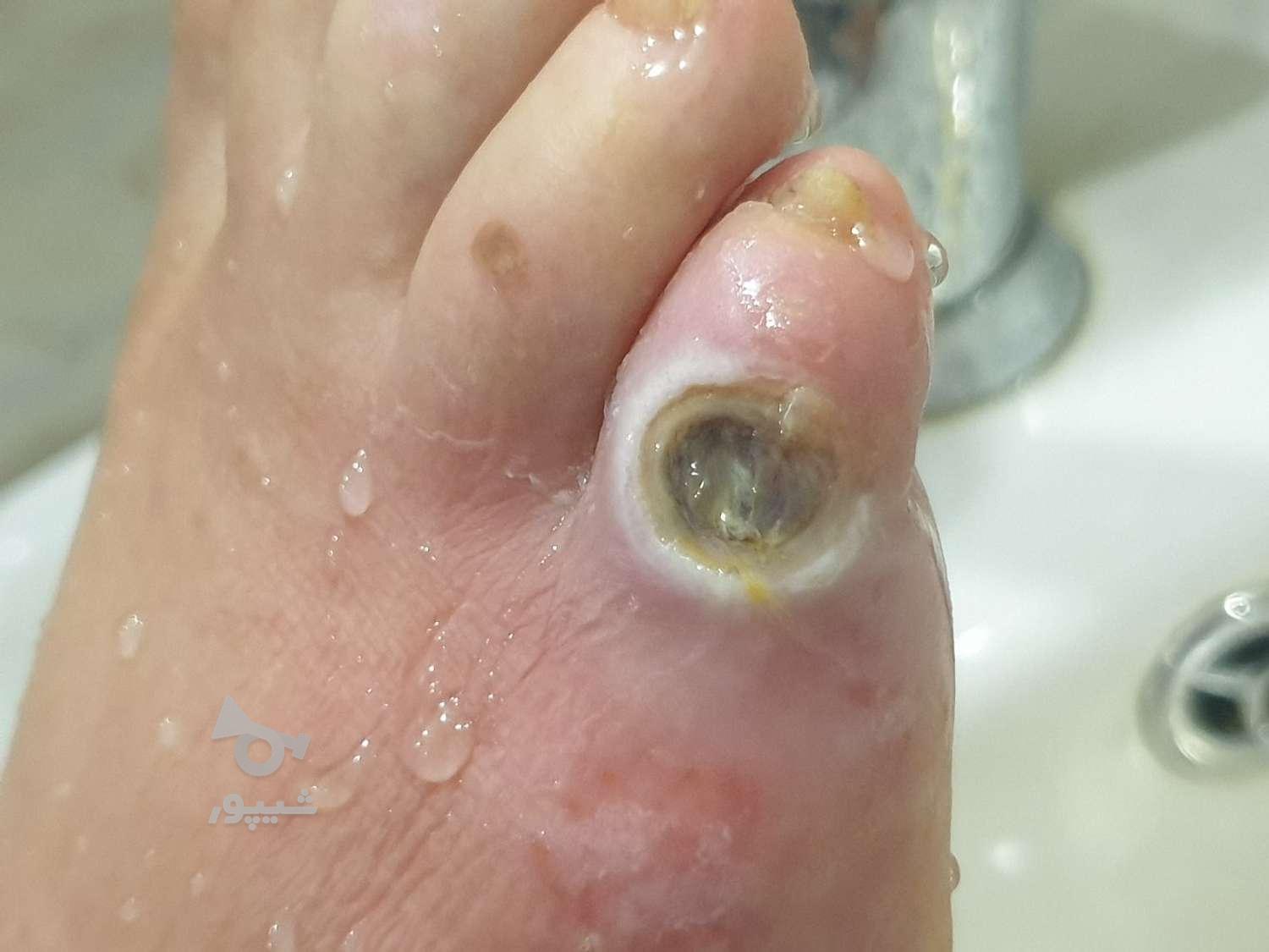 درمان انواع زخم پای دیابتی/بستر/جراحی/ارتوپدی