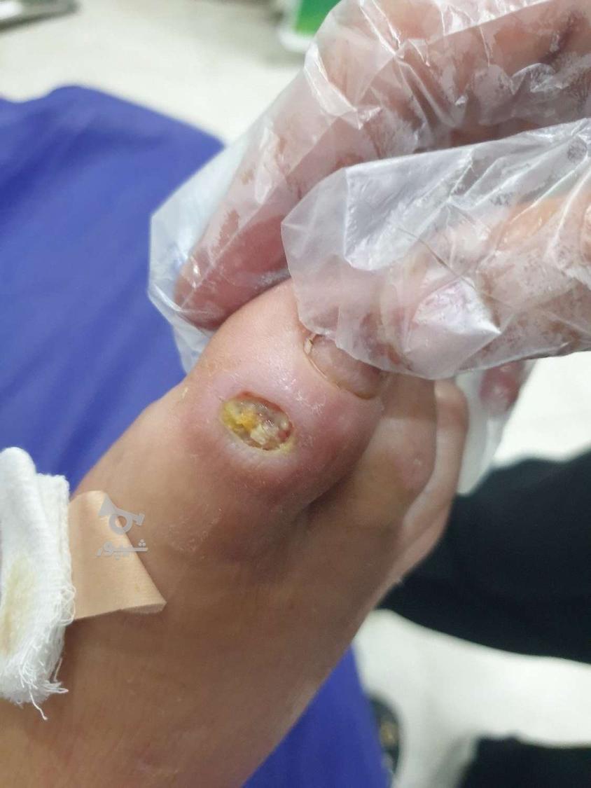 درمان انواع زخم پای دیابتی/بستر/جراحی/ارتوپدی