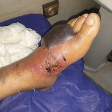 درمان انواع زخم پای دیابتی/بستر/جراحی/ارتوپدی