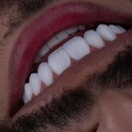 روکش زیرکونیا/ایمپلنت کره ای/ونیر