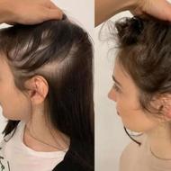 نازکی تارمو وریزش مو وریش نوجوانان