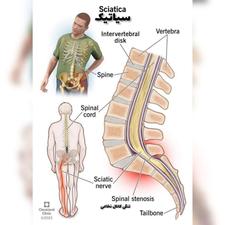 دیسک ،ارتروز،تنگی کانال،زانودرد درد مفاصل و...
