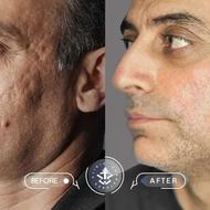 درمان تک جلسهای جای جوش و اسکار