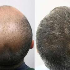 درمان ریزش مو