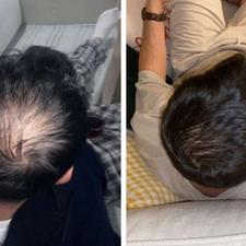 ریزش مو .شوره