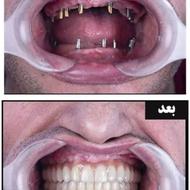 فستیوال دندانپزشکی تمام خدمات دندانپزشکی با 30درصد تخفیف