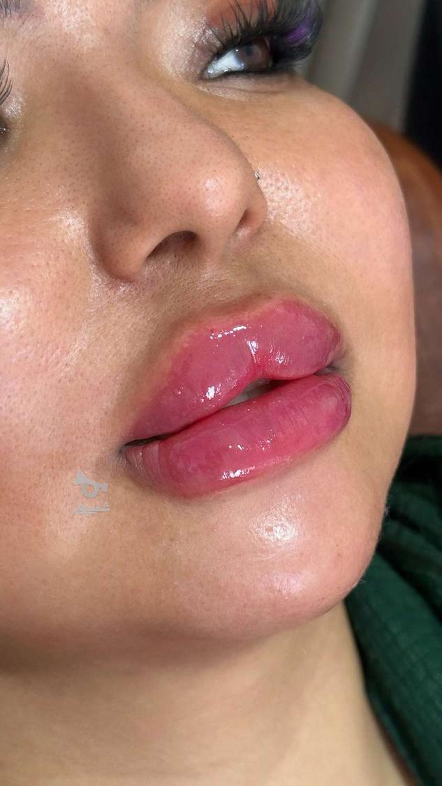 تزریق فیلر/ژل/پیرسینگ/پرسینگ/کاشت مژه