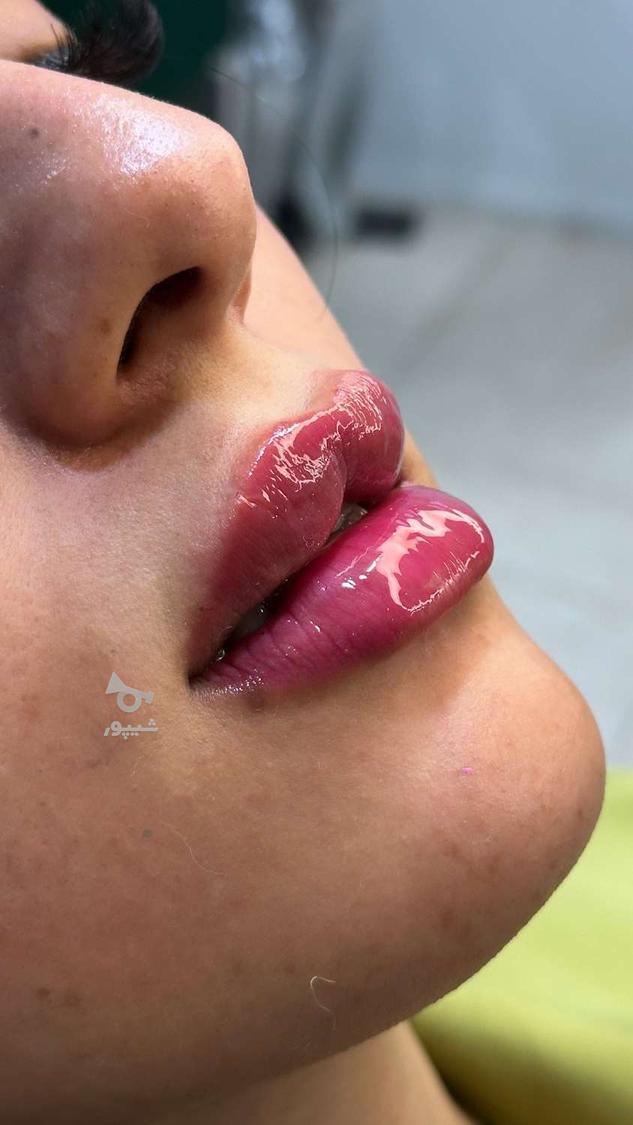 تزریق فیلر/ژل/پیرسینگ/پرسینگ/کاشت مژه