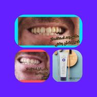 دیگه نیازی به ایمپلنت نیس خمیردندان بنفش سفید کننده دنتالند.