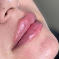 تزریق ژل و بوتاکس