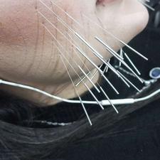 طب سوزنی و زیبایی صورت