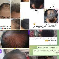 درمان قطعی ریزش مو و رشد مجدد موها