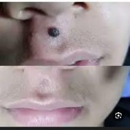 برداشت انواع خال وزگیل