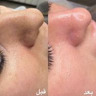 درمان انواع لک صورت