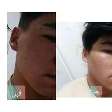 درمان‌ انواع مشکلات پوست صورت