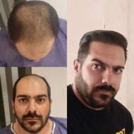 کاشت مو توسط پزشک با 18 سال سابقه(ضمانت‌نامه کتبی)
