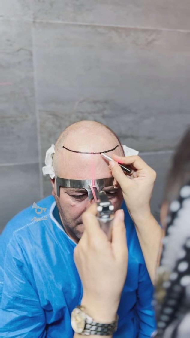 کاشت تخصصی مو با ضمانت