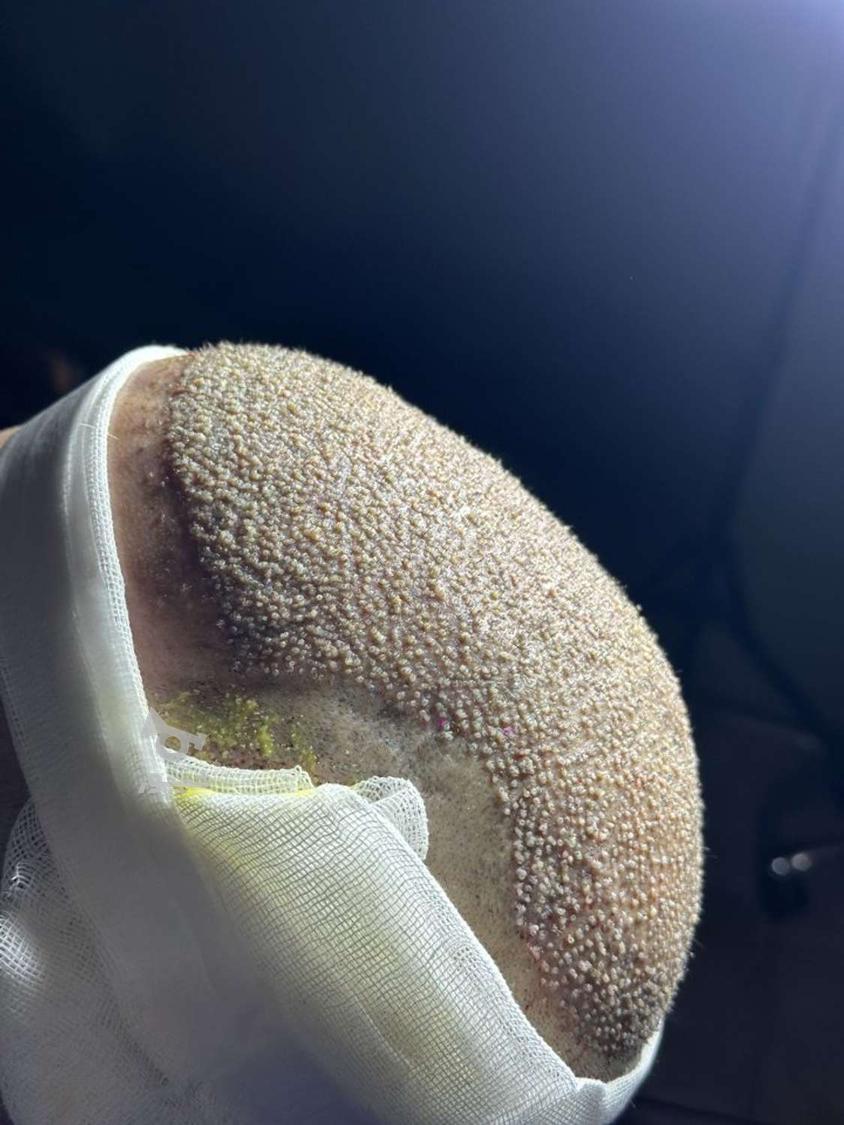 کاشت تخصصی مو با ضمانت