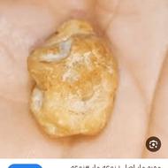 مهره مار یا زوعه مار وسنگ عقیق زرد یمنی با کلمات قرانی