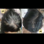 درمان ریزش و رویش مجدد مو