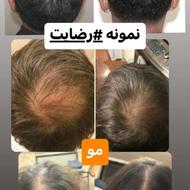 درمان مشکل مو از جمله‌ ریزش و...