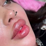 تزریق ژلوفیلر تخفیف ویژه شب عید