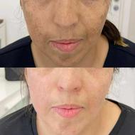 تا عید از لک و تیرگی و جوش صورتت خدافظی کن