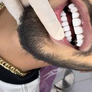 کامپوزیت دندان