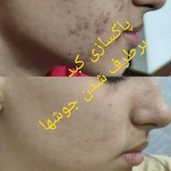 درمان مشکلات پوستی ،پاکسازی بدن