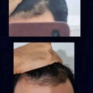 رشد مجدد مو و قطع ریزش مو