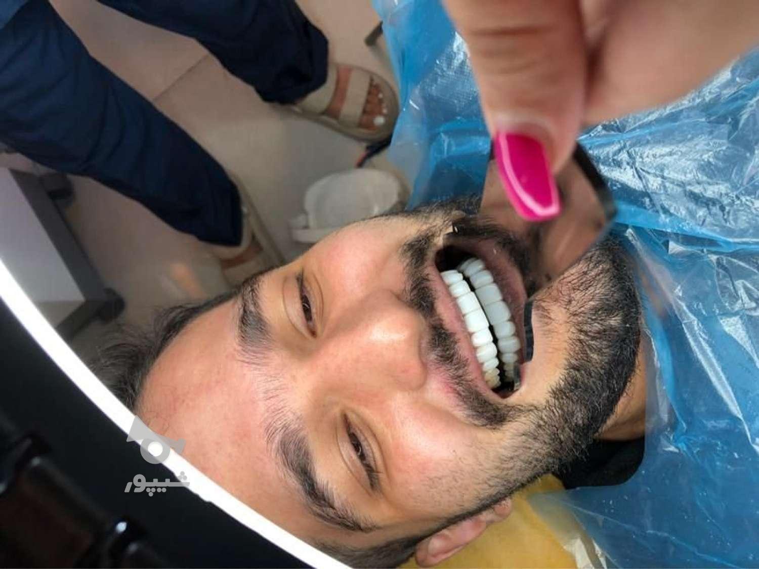 اقساط ایمپلنت تخصصی کامپوزیت لمینیت ارتودنسی