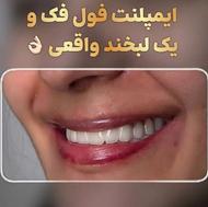 اقساط ایمپلنت تخصصی کامپوزیت لمینیت ارتودنسی