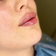 تزریق تخصصی فیلر در ساری