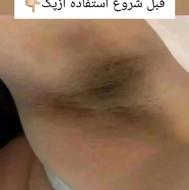 رفع تیرگی بدن