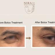 تزریق بوتاکس و پی ار پی