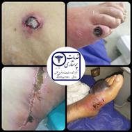 کنترل عفونت و پانسمان زخم بخیه درن جراحی|عفونی|ارتوپدی|دیابت