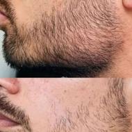 مشکل کمپشتی ریش وسبیل