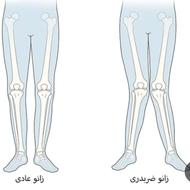 مرکز ارتوپدی درمان غیرجراحی انحرافات زانو