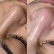 پاکسازی و فیشال پوست