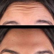 تزریق ژل رووفیل در مطب