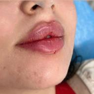 تخفیف استثنایی لیزر و بوتاکس