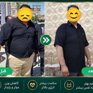 تجربه لاغری با ترزیق تیرزپاتاید در مرکز دکتر پورعلی(متد 2026